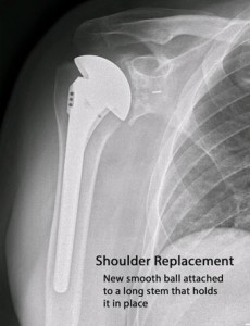 X-ray of shoulder post surgery