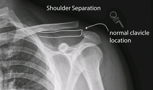 Shoulder separation x-ray